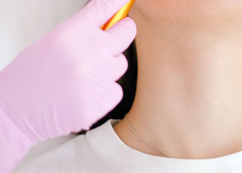 Hyaluronic acid fillers